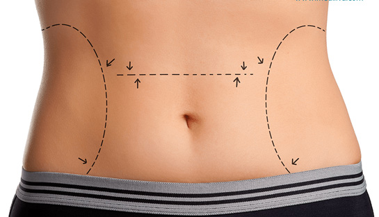 Bel Çukuru Nedir ve Tehlikeli midir?