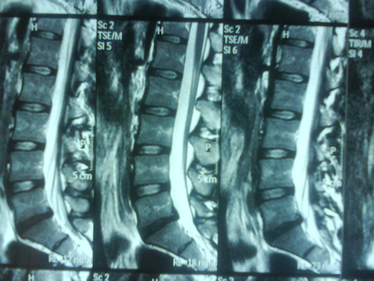 Bel Fıtığı L5 S1 Nedir?