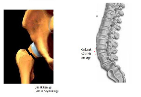 Bel Kırılması Belirtileri ve Tedavisi