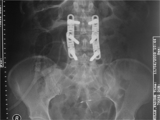 Bele Platin Takılması